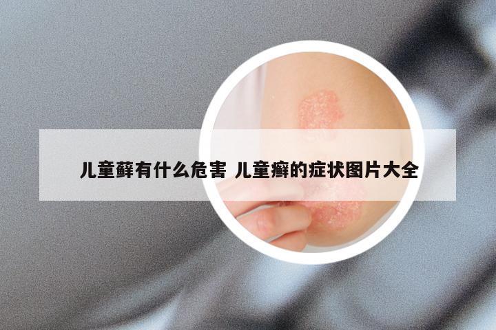 儿童藓有什么危害 儿童癣的症状图片大全