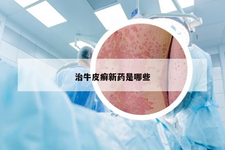 治牛皮癣新药是哪些