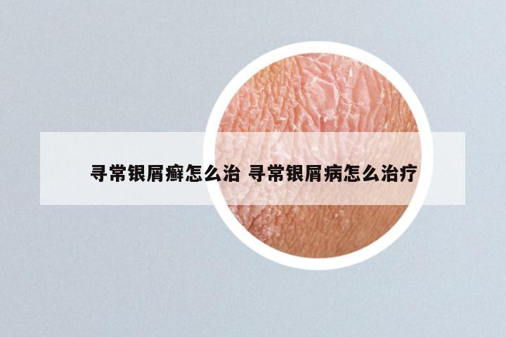 寻常银屑癣怎么治 寻常银屑病怎么治疗