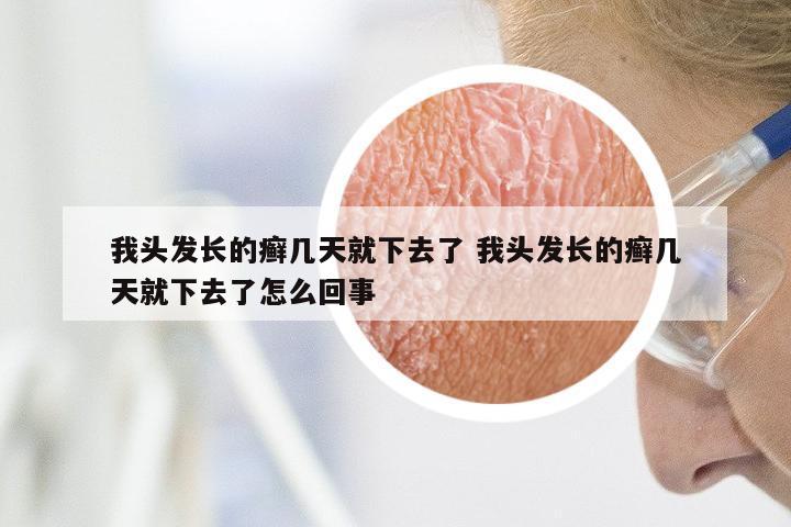 我头发长的癣几天就下去了 我头发长的癣几天就下去了怎么回事