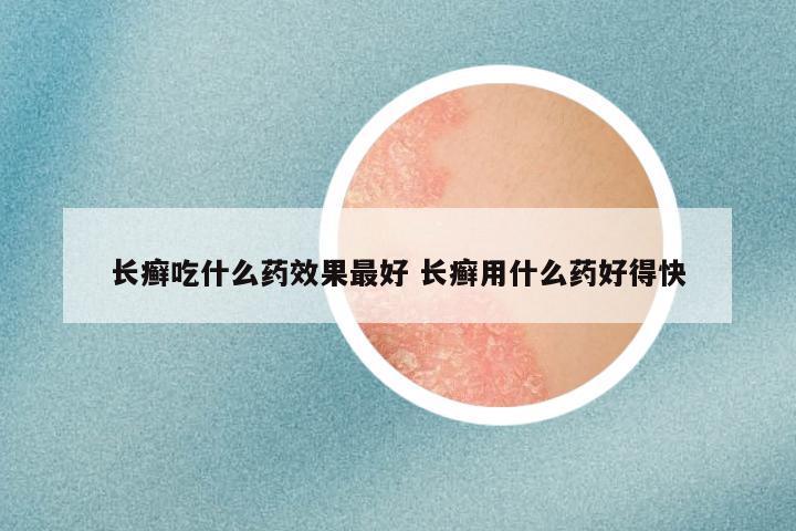 长癣吃什么药效果最好 长癣用什么药好得快