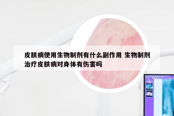 皮肤病使用生物制剂有什么副作用 生物制剂治疗皮肤病对身体有伤害吗