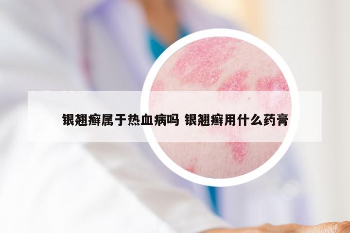银翘癣属于热血病吗 银翘癣用什么药膏