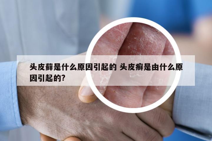 头皮藓是什么原因引起的 头皮癣是由什么原因引起的?