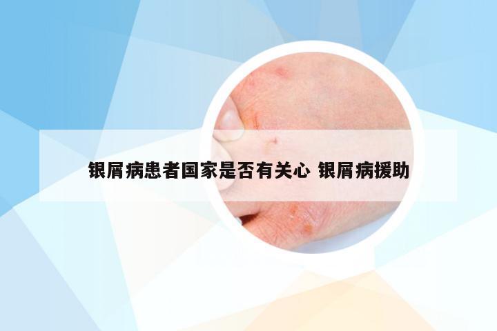 银屑病患者国家是否有关心 银屑病援助