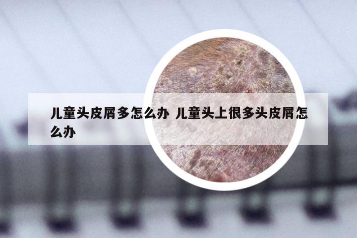 儿童头皮屑多怎么办 儿童头上很多头皮屑怎么办