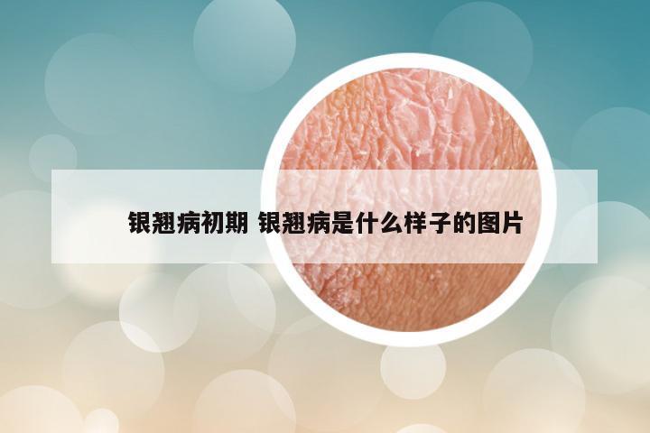 银翘病初期 银翘病是什么样子的图片