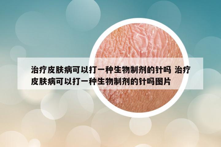 治疗皮肤病可以打一种生物制剂的针吗 治疗皮肤病可以打一种生物制剂的针吗图片