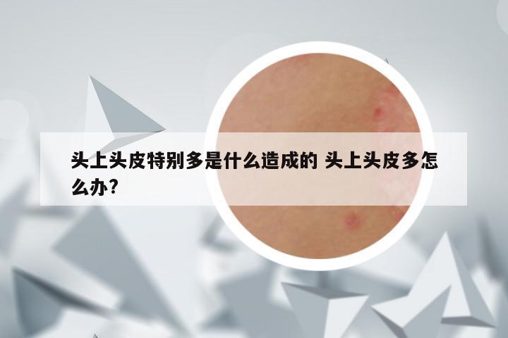 头上头皮特别多是什么造成的 头上头皮多怎么办?