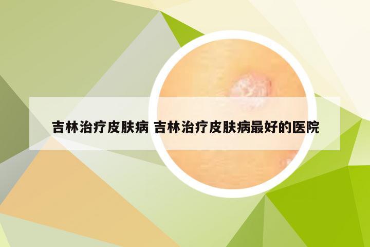 吉林治疗皮肤病 吉林治疗皮肤病最好的医院