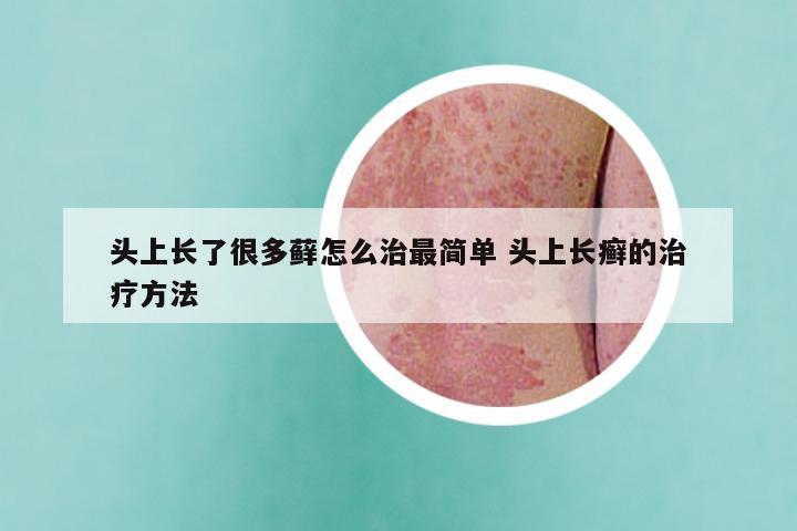 头上长了很多藓怎么治最简单 头上长癣的治疗方法