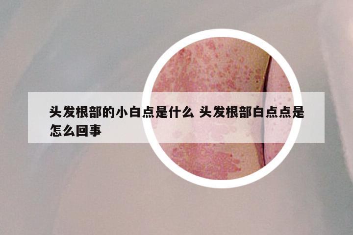 头发根部的小白点是什么 头发根部白点点是怎么回事