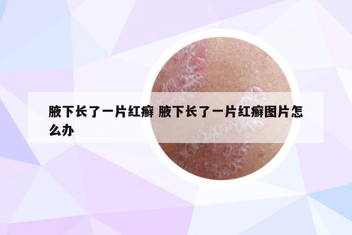 腋下长了一片红癣 腋下长了一片红癣图片怎么办