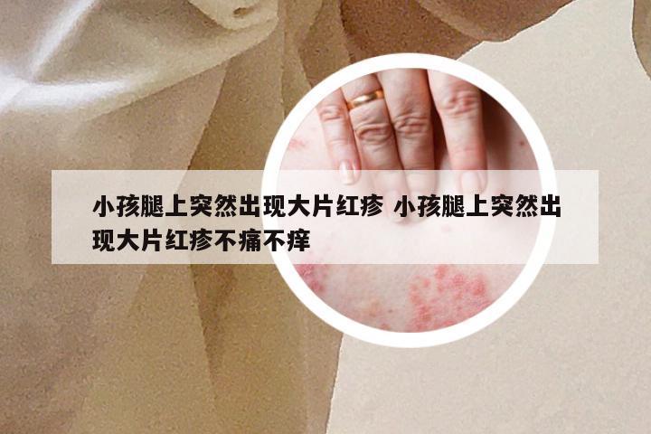 小孩腿上突然出现大片红疹 小孩腿上突然出现大片红疹不痛不痒