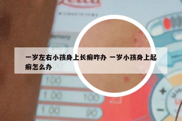 一岁左右小孩身上长癣咋办 一岁小孩身上起癣怎么办