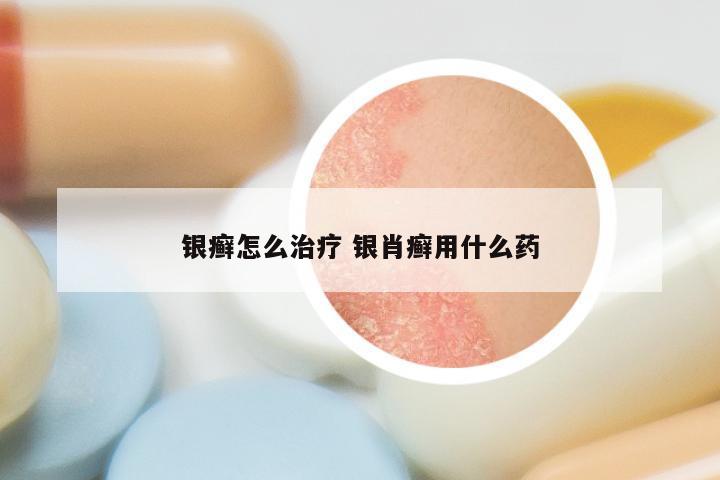 银癣怎么治疗 银肖癣用什么药