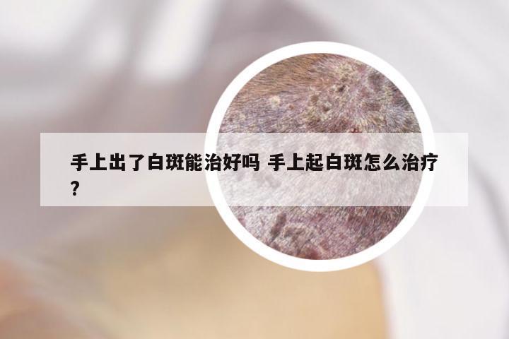 手上出了白斑能治好吗 手上起白斑怎么治疗?