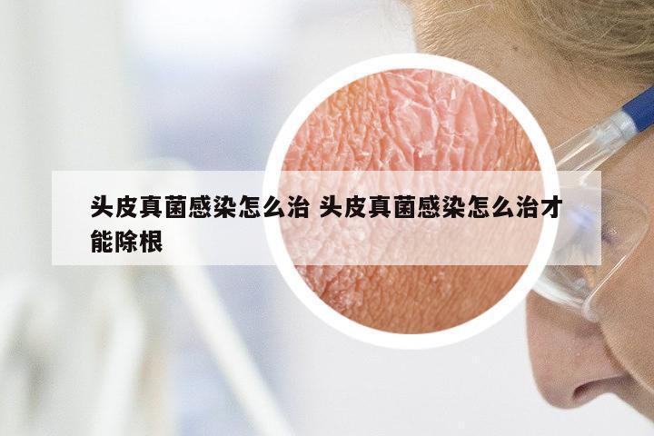 头皮真菌感染怎么治 头皮真菌感染怎么治才能除根