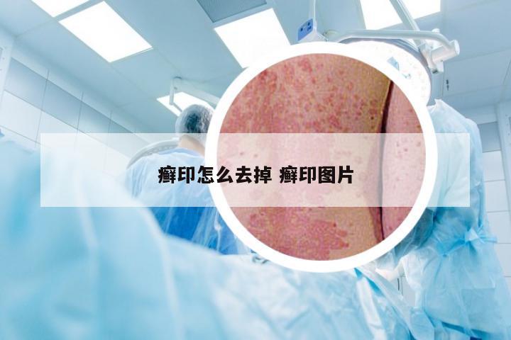 癣印怎么去掉 癣印图片