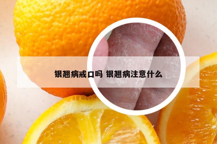 银翘病戒口吗 银翘病注意什么