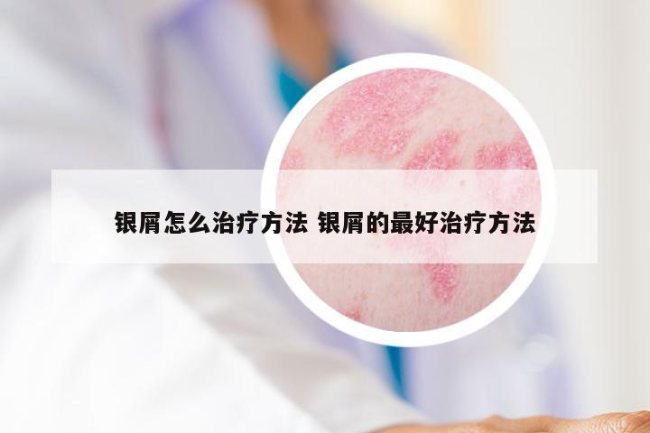 银屑怎么治疗方法 银屑的最好治疗方法