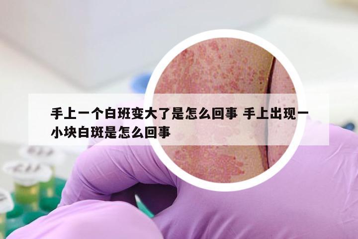 手上一个白班变大了是怎么回事 手上出现一小块白斑是怎么回事