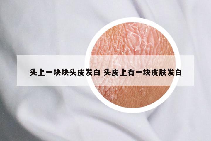 头上一块块头皮发白 头皮上有一块皮肤发白