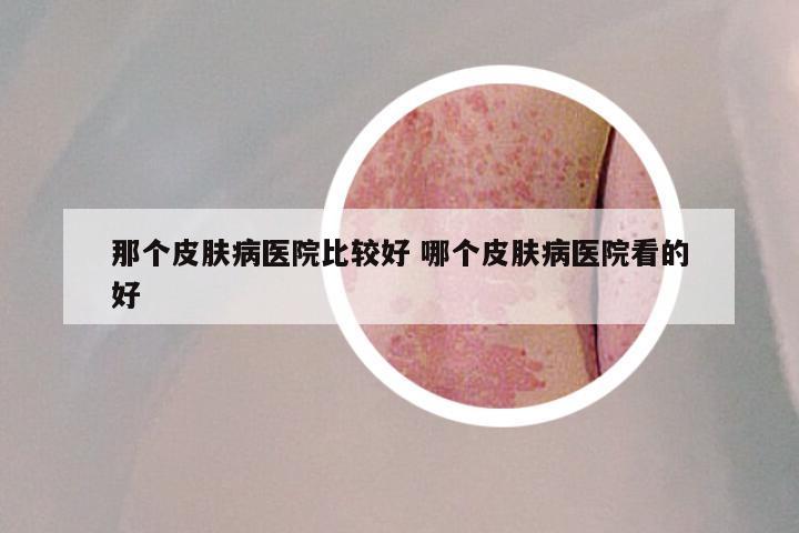 那个皮肤病医院比较好 哪个皮肤病医院看的好