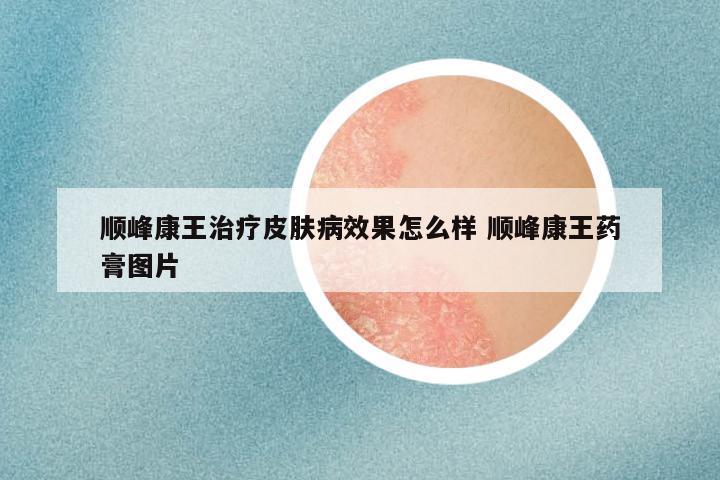 顺峰康王治疗皮肤病效果怎么样 顺峰康王药膏图片