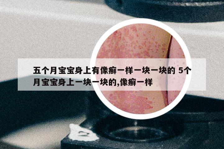 五个月宝宝身上有像癣一样一块一块的 5个月宝宝身上一块一块的,像癣一样