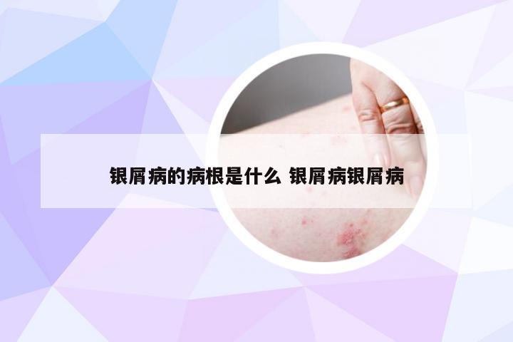 银屑病的病根是什么 银屑病银屑病