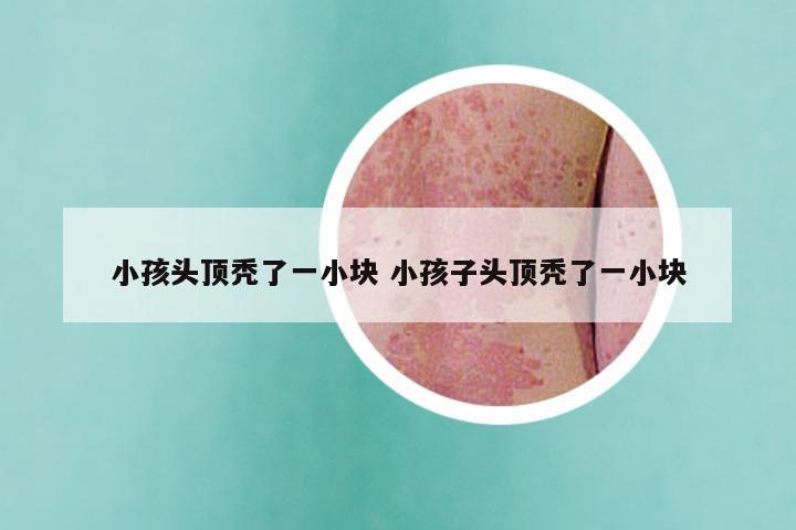 小孩头顶秃了一小块 小孩子头顶秃了一小块