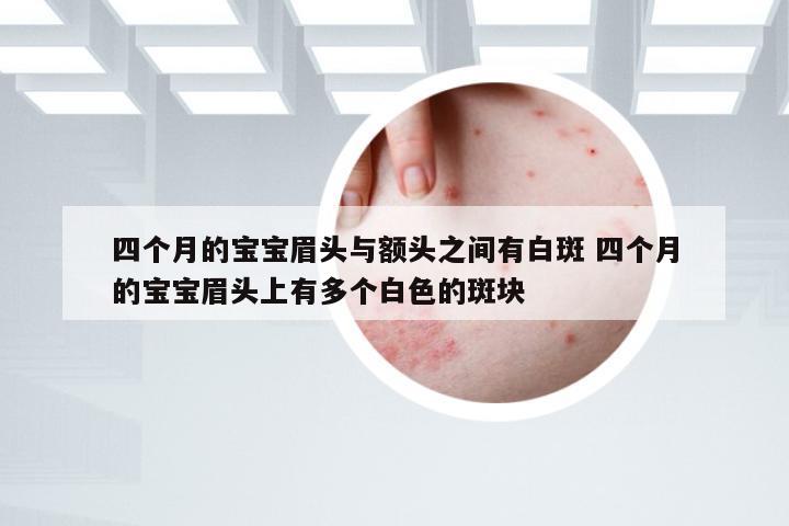 四个月的宝宝眉头与额头之间有白斑 四个月的宝宝眉头上有多个白色的斑块