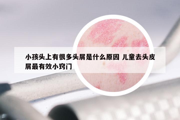 小孩头上有很多头屑是什么原因 儿童去头皮屑最有效小窍门