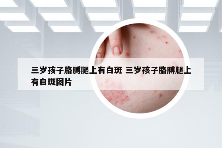 三岁孩子胳膊腿上有白斑 三岁孩子胳膊腿上有白斑图片