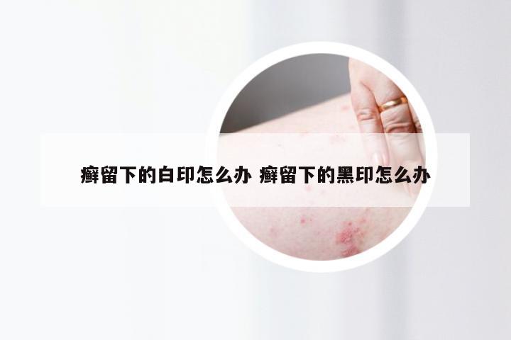 癣留下的白印怎么办 癣留下的黑印怎么办