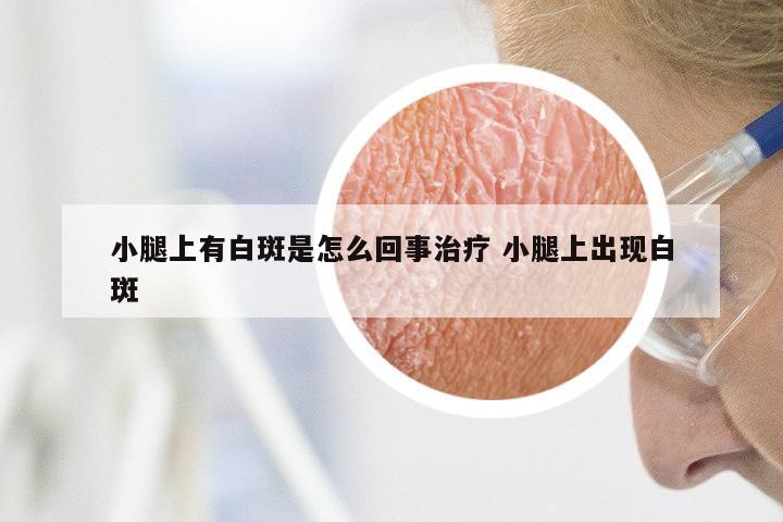 小腿上有白斑是怎么回事治疗 小腿上出现白斑