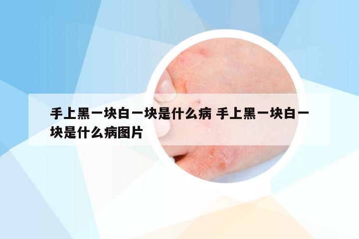 手上黑一块白一块是什么病 手上黑一块白一块是什么病图片