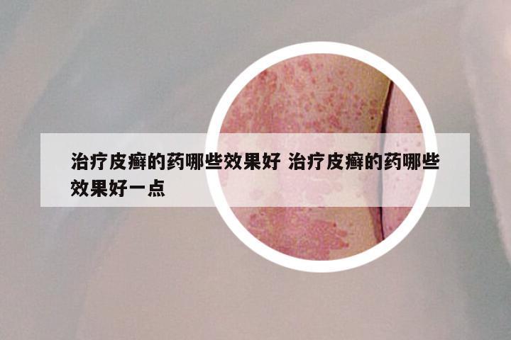 治疗皮癣的药哪些效果好 治疗皮癣的药哪些效果好一点