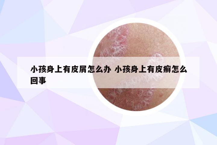 小孩身上有皮屑怎么办 小孩身上有皮癣怎么回事