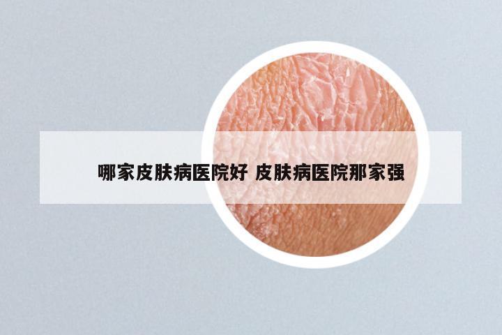 哪家皮肤病医院好 皮肤病医院那家强