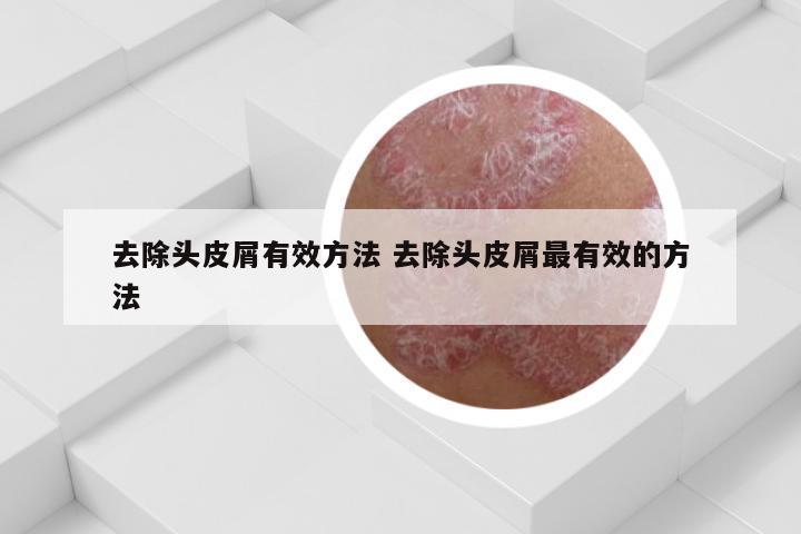 去除头皮屑有效方法 去除头皮屑最有效的方法