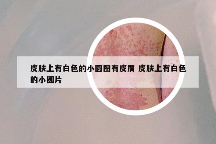 皮肤上有白色的小圆圈有皮屑 皮肤上有白色的小圆片
