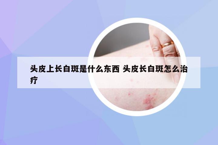 头皮上长白斑是什么东西 头皮长白斑怎么治疗