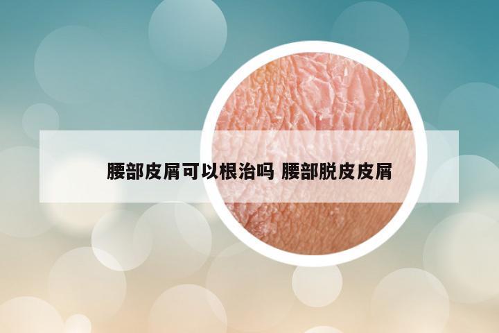 腰部皮屑可以根治吗 腰部脱皮皮屑