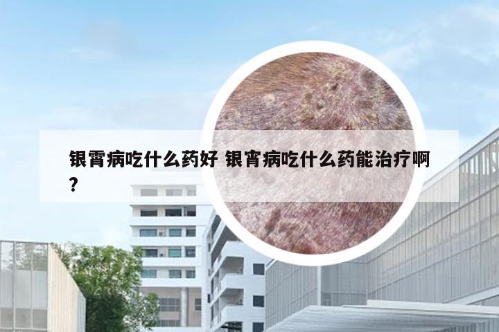 银霄病吃什么药好 银宵病吃什么药能治疗啊?