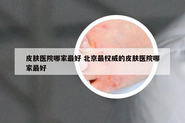 皮肤医院哪家最好 北京最权威的皮肤医院哪家最好