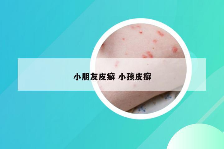 小朋友皮癣 小孩皮癣