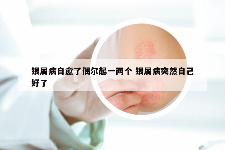 银屑病自愈了偶尔起一两个 银屑病突然自己好了