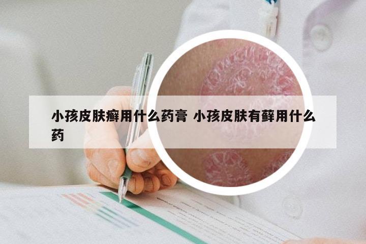 小孩皮肤癣用什么药膏 小孩皮肤有藓用什么药